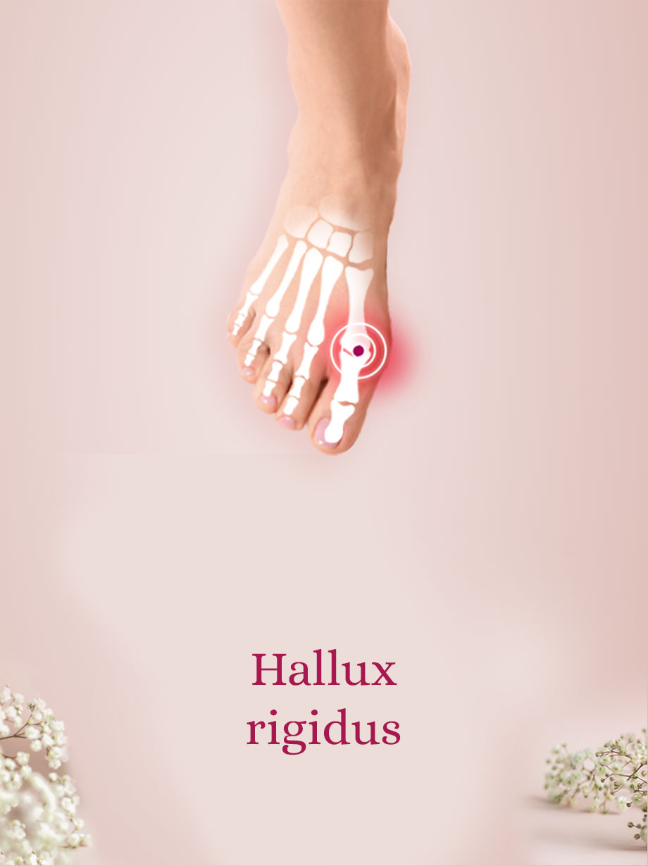 Hallux-rigidus